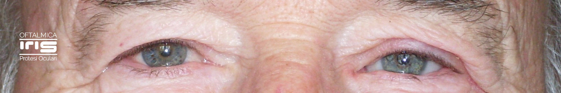 protesi oculare realizzato da oftalmica iris - genova - occhi azzurri